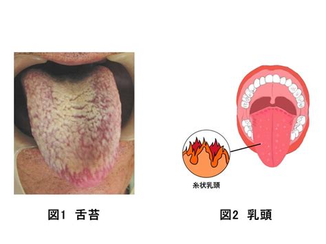 舌苔画像倉庫